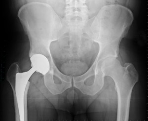 If you have been affected by the Depuy ASR hip implant recall then call us today at (205) 201-1789 Birmingham AL defective medical device lawyers